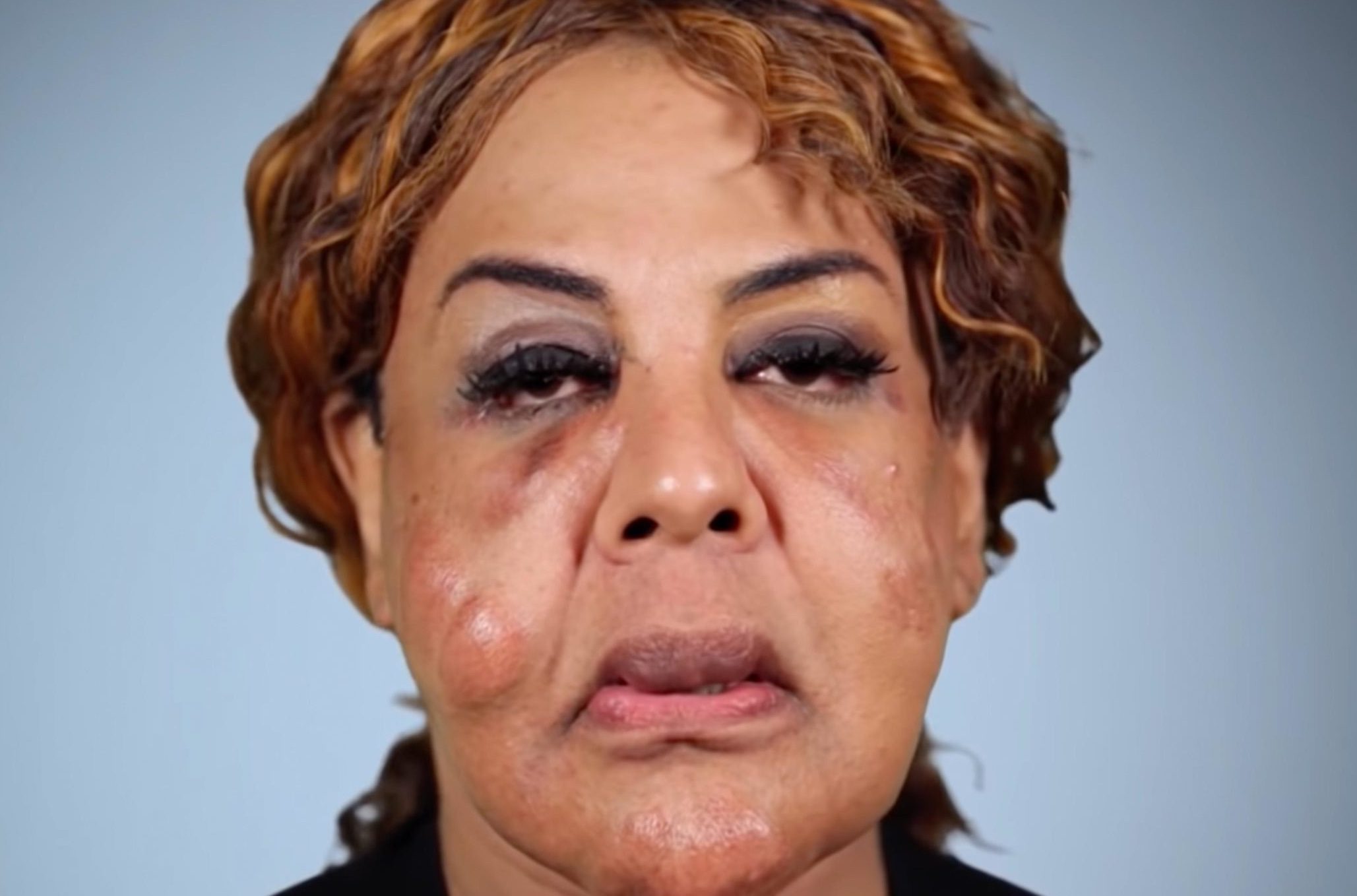 Ein bösartiger “Arzt” pumpte ihr Gesicht mit Zement voll – so sieht sie heute aus ➤ Buzzday.info