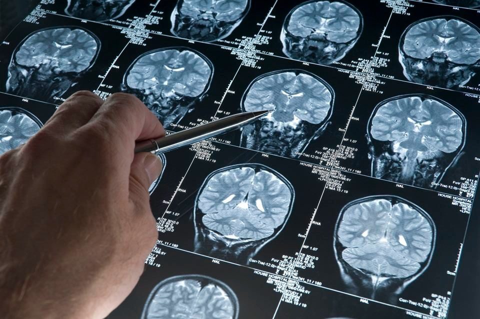 Alzheimer: novo teste diagnostica 15 anos antes dos sintomas