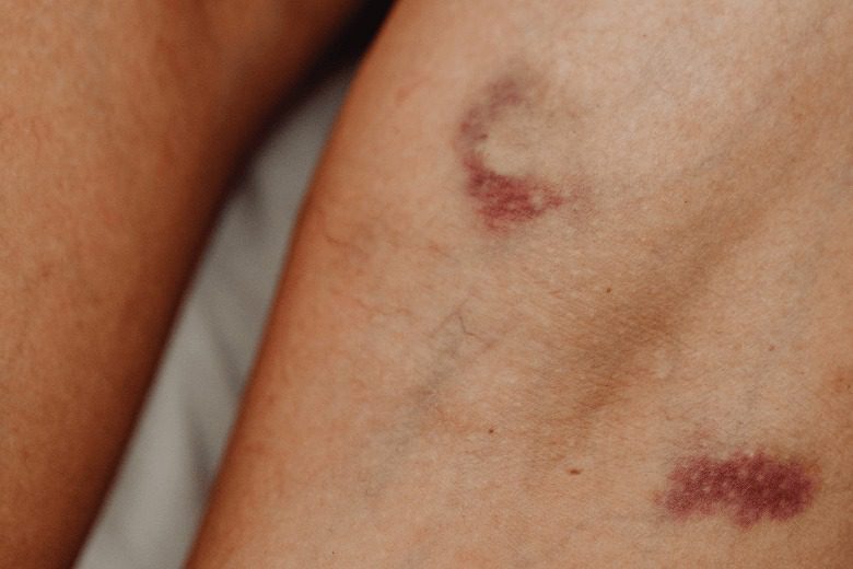 Você sempre tem hematomas inexplicáveis? pode ser por isso