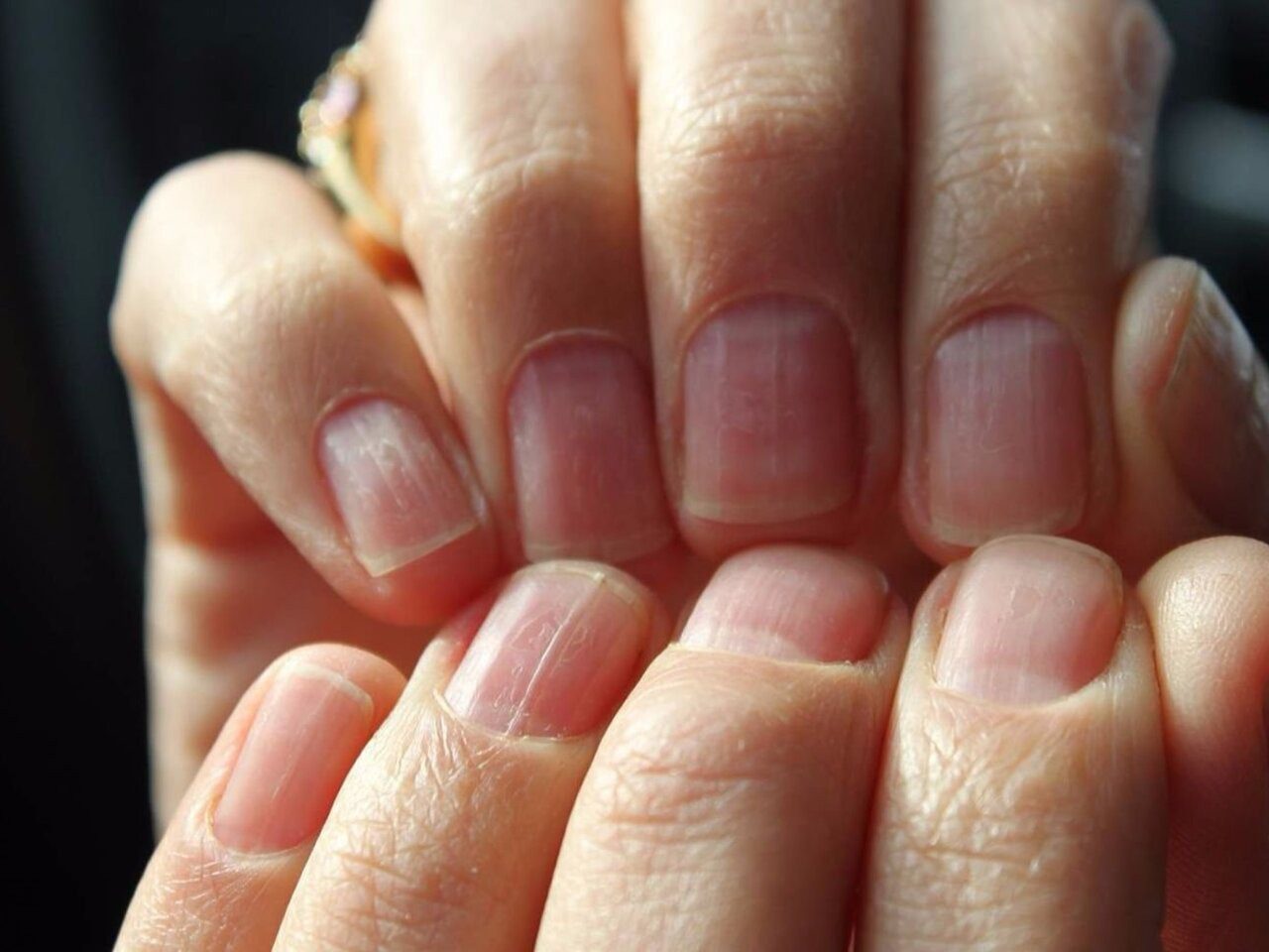 Por que as unhas ficam estriadas: um sinal vital ➤ Buzzday.info