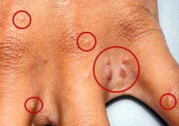 Pequenos pontos vermelhos: o sintoma que poucos reconhecem ➤ Buzzday.info
