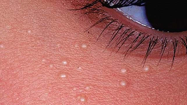 El significado de por qué a veces aparecen pequeñas manchas blancas en el cuerpo. A veces pueden tener problemas graves. ➤ Buzzday.info