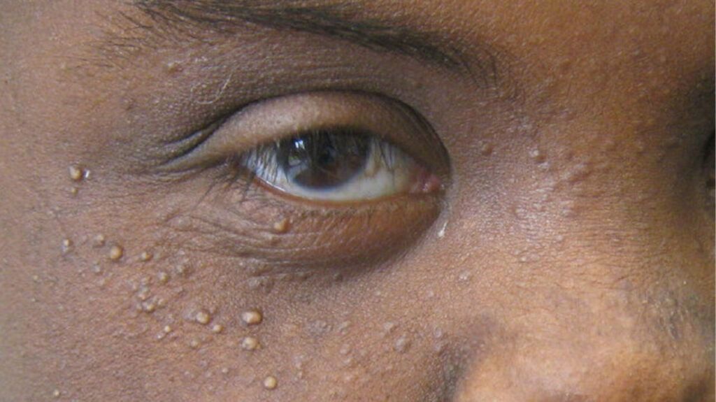 El significado de por qué a veces aparecen pequeñas manchas blancas en el cuerpo. A veces pueden tener problemas graves.